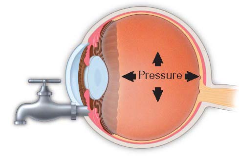 glaucoma-pressure