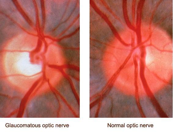 optic-nerve