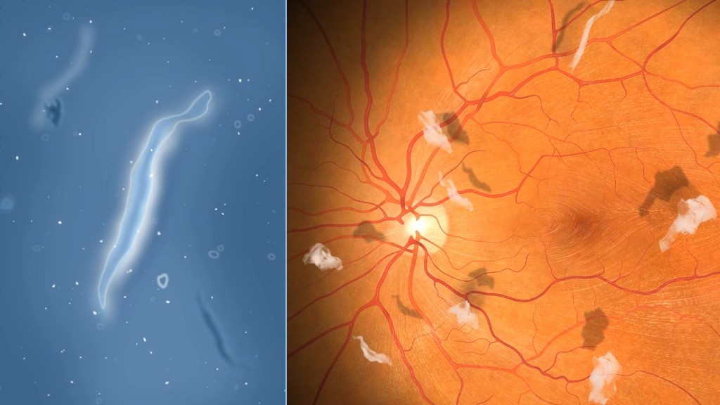 floaters after retina surgery